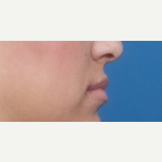 25-34 year old woman treated with Injectable Fillers before 3764280