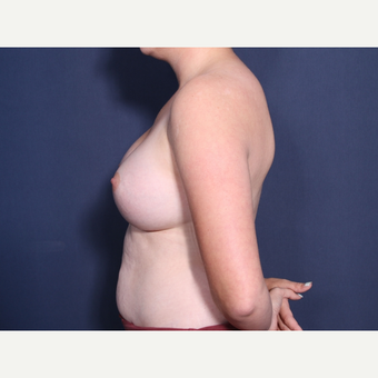18-24 year old woman treated with Breast Augmentation (view 2 of2) after 3782383