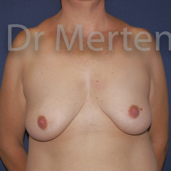 35-44 year old woman treated with Breast Lift with Implants before 3591911