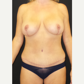 45-54 year old woman treated with Mommy Makeover after 3306116