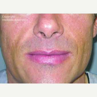 Bellafill Permanent Filler for Nasolabial Folds after 2988752