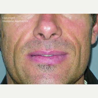 Bellafill Permanent Filler for Nasolabial Folds before 2988752
