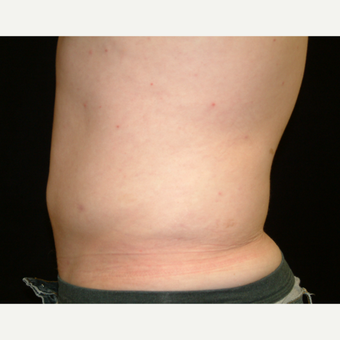 18-24 year old man treated with Liposuction Abdomen after 3141966
