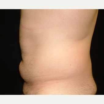 18-24 year old man treated with Liposuction Abdomen before 3141966