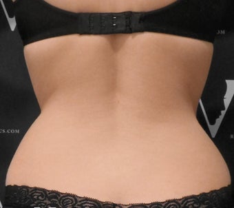 Coolsclupting treatment for contouring the flanks before 3265106