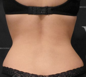 Coolsclupting treatment for contouring the flanks after 3265106