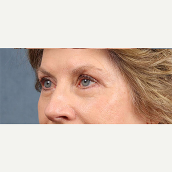 Eyelid Surgery after 3123730