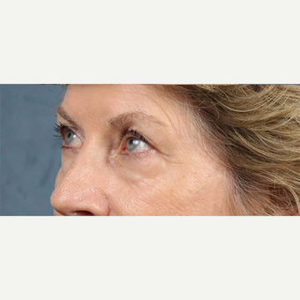 Eyelid Surgery before 3123730