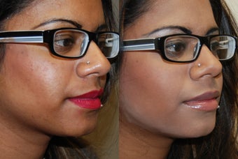 Silikon-1000 lip augmentation. before 1414639