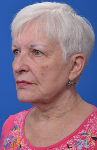 74 year old woman treated with Quick Lift before 2093615
