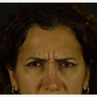 Botox – Preventative and Rejuvenating before 3691708