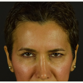 Botox – Preventative and Rejuvenating after 3691708