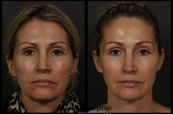 Sculptra before 316998