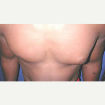 25-34 year old man treated with left Male Breast Reduction (Gynecomastia) before 3013143