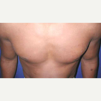 25-34 year old man treated with left Male Breast Reduction (Gynecomastia) after 3013143