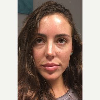 25-34 year old woman treated with Lip Augmentation after 3769703