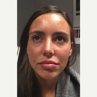 25-34 year old woman treated with Lip Augmentation before 3769703