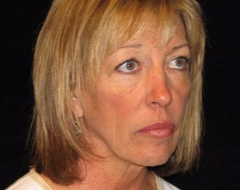 55-64 year old woman treated with Facelift, quad blepharoplasty before 2509167