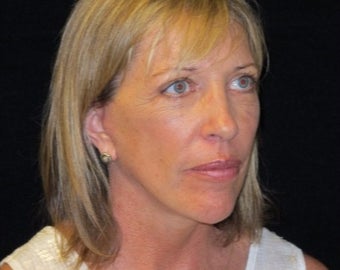 55-64 year old woman treated with Facelift, quad blepharoplasty after 2509167