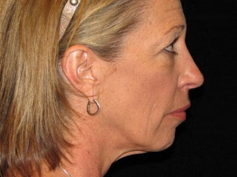 55-64 year old woman treated with Facelift, quad blepharoplasty 2509167