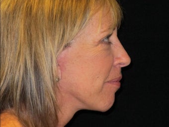 55-64 year old woman treated with Facelift, quad blepharoplasty 2509167
