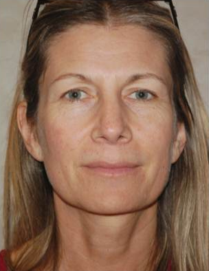 Brow Lift with Facial Fat Grafting before 660513
