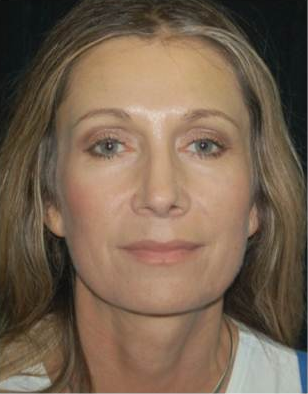 Brow Lift with Facial Fat Grafting after 660513