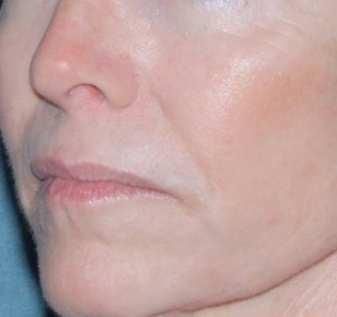 Laser Resurfacing for Wrinkles after 658911