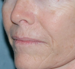 Laser Resurfacing for Wrinkles before 658911
