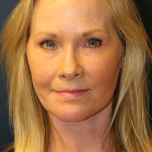 55-64 year old woman treated with Facelift after 3554109
