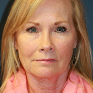 55-64 year old woman treated with Facelift before 3554109