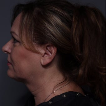 55 year old woman treated with Kybella after 2225197