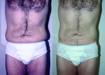 45-year-old man treated with Liposuction. before 3287556