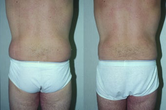 45-year-old man treated with Liposuction. after 3287556
