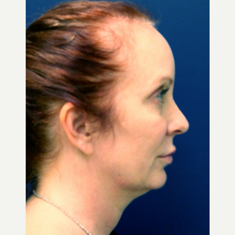 35-44 year old woman treated with Smart Lipo before 3143144