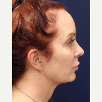 35-44 year old woman treated with Smart Lipo after 3143144