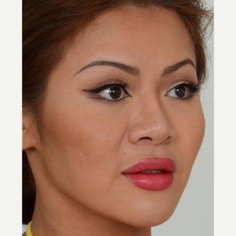25-34 year old woman treated with Masseter Botox for Jaw Reduction after 2561316
