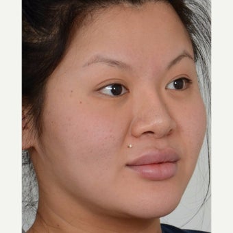 25-34 year old woman treated with Masseter Botox for Jaw Reduction before 2561316