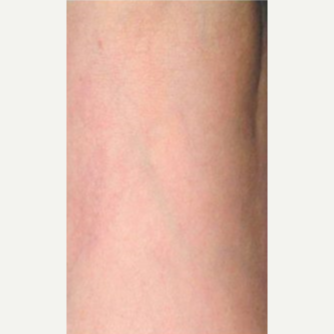 45-54 year old woman treated with Vein Treatment after 3499350