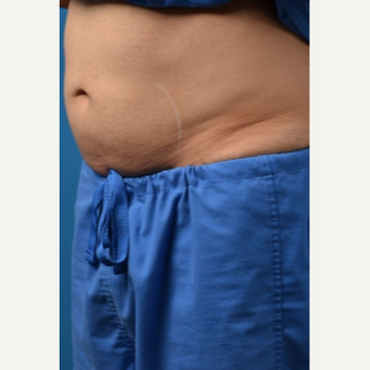 35-44 year old man treated with SculpSure before 3414123