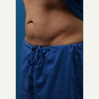35-44 year old man treated with SculpSure after 3414123