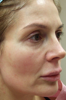 Lipo-augmentation of Face before 295940