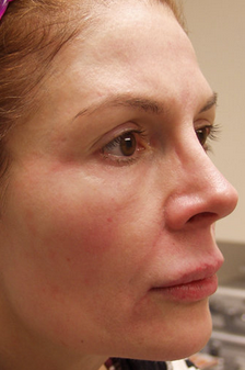 Lipo-augmentation of Face after 295940