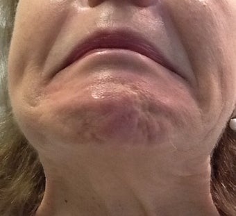 Botox for a 71 year-old woman with downturned corners of her mouth and a dimpled chin before 1469237