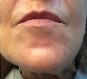 Botox for a 71 year-old woman with downturned corners of her mouth and a dimpled chin after 1469237
