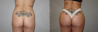 25-34 year old woman treated with Brazilian Butt Lift before 2017707