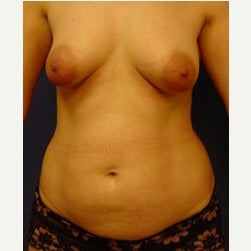 35-44 year old woman treated with Liposuction before 2045065