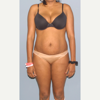 25-34 year old woman treated with Tummy Tuck before 3559019
