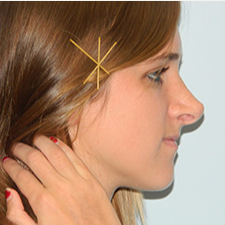 18-24 year old woman treated with Rhinoplasty before 3459383
