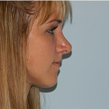 18-24 year old woman treated with Rhinoplasty after 3459383